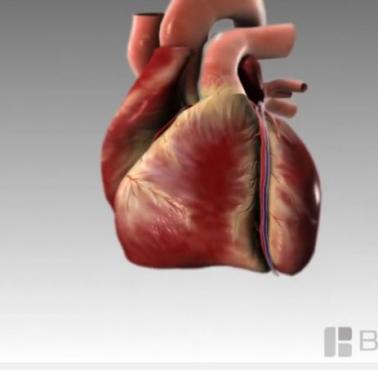 Jak wygląda atak serca (animacja)