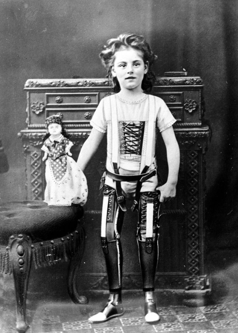 Dziewczynka z protezami nóg wykonanych przez Jamesa Gillinghama, 1900