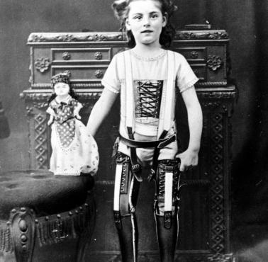 Dziewczynka z protezami nóg wykonanych przez Jamesa Gillinghama, 1900