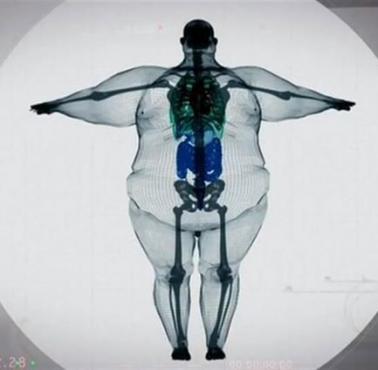 Tkanka tłuszczowa i szkielet osoby otyłej