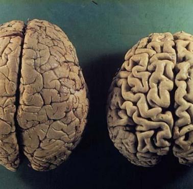 Zdrowy mózg i mózg osoby cierpiącej na chorobę Alzheimera