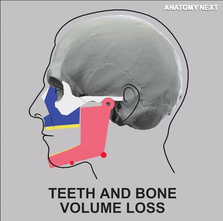 Co się dzieje z żuchwą człowieka po stracie zębów (animacja)