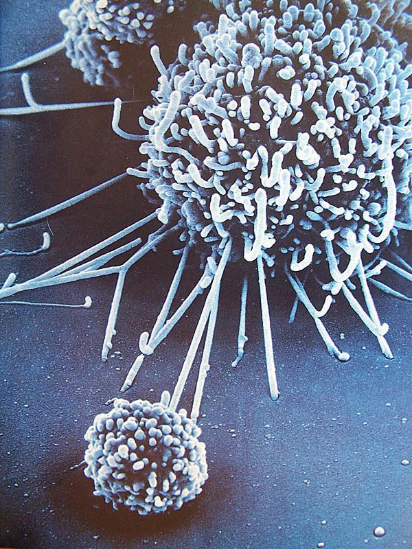 Zdjęcie z mikroskopu elektronowego przedstawiające atak komórki systemu autoimmunologicznego na dużą komórkę nowotworową