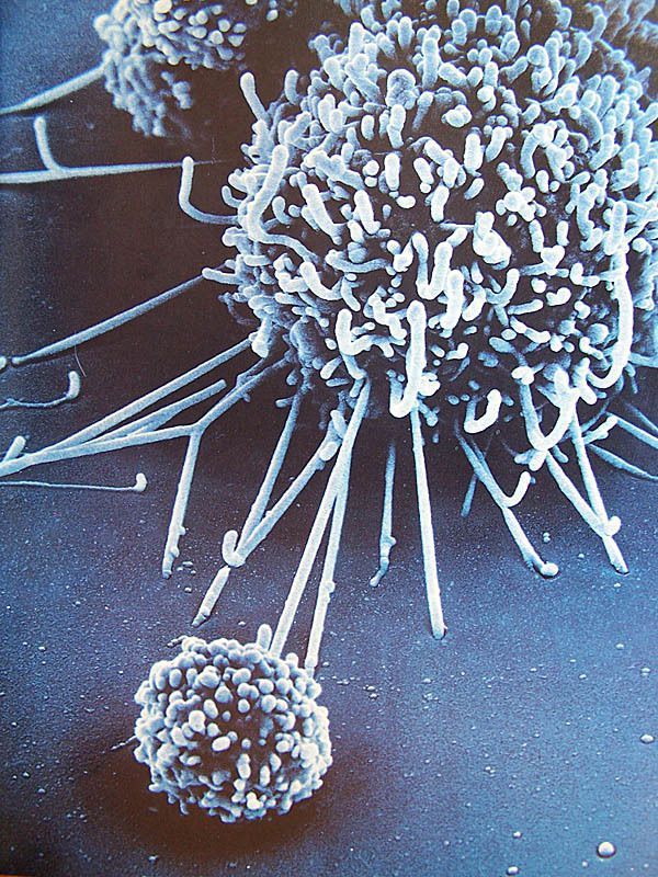 Zdjęcie z mikroskopu elektronowego przedstawiające atak komórki systemu autoimmunologicznego na dużą komórkę nowotworową