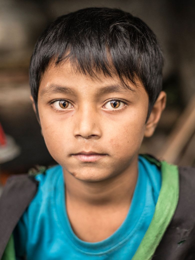 Nepalski chłopiec cierpiący na zespół kociego oka spowodowany nieprawidłowościami budowy chromosomu 22