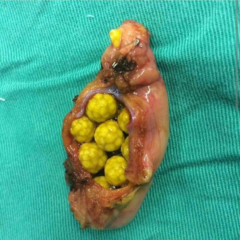 Złogi cholesterolu
