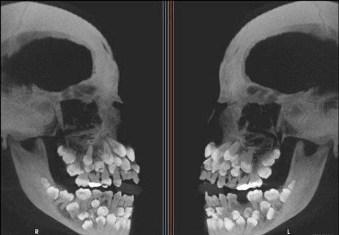 Zdjęcie rentgenowskie czaszki osoby cierpiącej na hiperdoncję (zęby nadliczbowe)