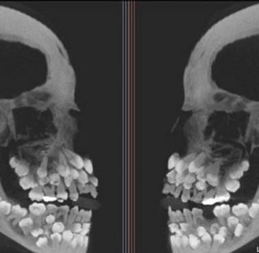 Zdjęcie rentgenowskie czaszki osoby cierpiącej na hiperdoncję (zęby nadliczbowe)
