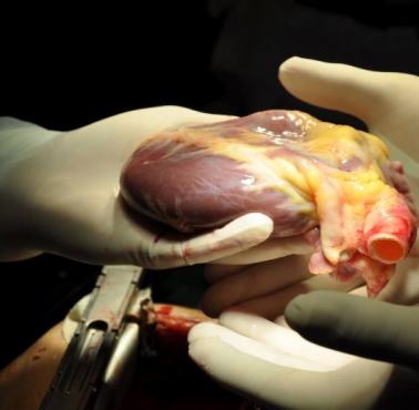 Bijące serce przekazane chirurgowi chwilę przed przeszczepem