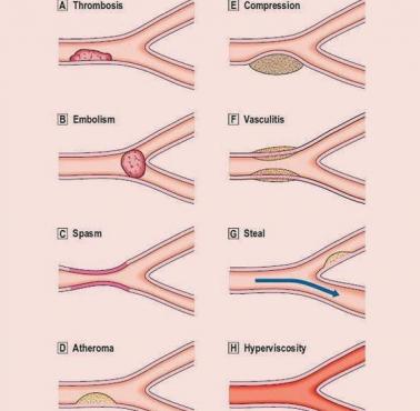 Różne procesy patologiczne, które mogą wystąpić w naczyniach krwionośnych