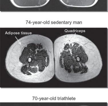 Mózg 40 i 70-letniego triatlonisty w porównaniu do mózgu mężczyzny prowadzącego siedzący tryb życia w wieku 70-lat