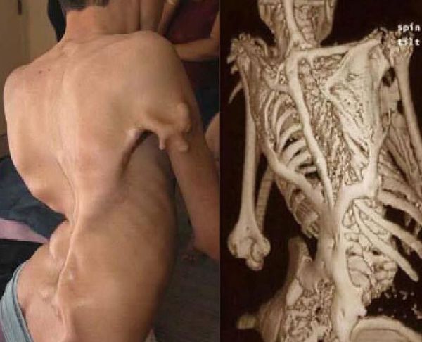 Rzadka choroba genetyczna - postępujące kostniejące zapalenie mięśni (fibrodysplazja)