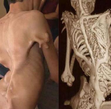 Rzadka choroba genetyczna - postępujące kostniejące zapalenie mięśni (fibrodysplazja)