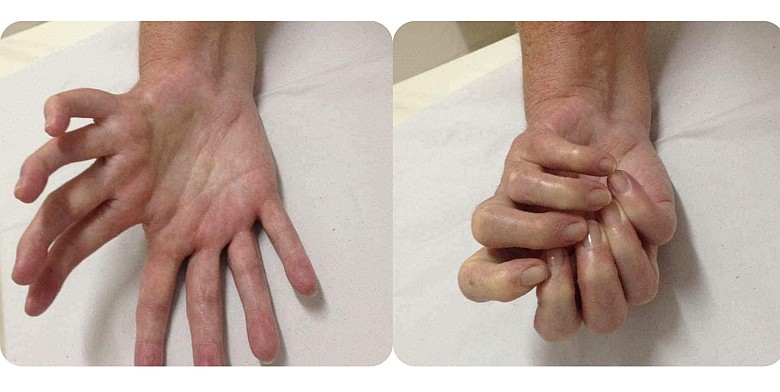 Rzadka wada genetyczna - Laurin-Sandrow syndrome (LSS)