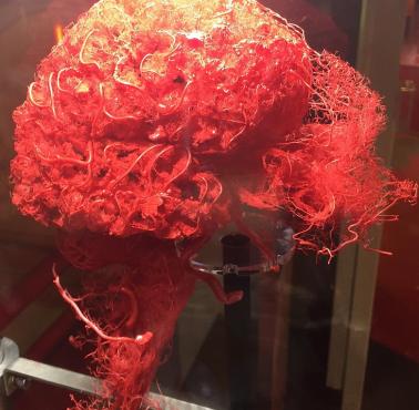 Mózg z odsłoniętymi naczyniami krwionośnymi