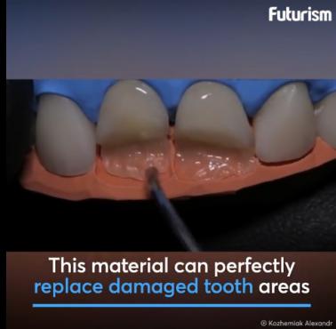 Rekonstrukcja przednich zębów (wideo HD)