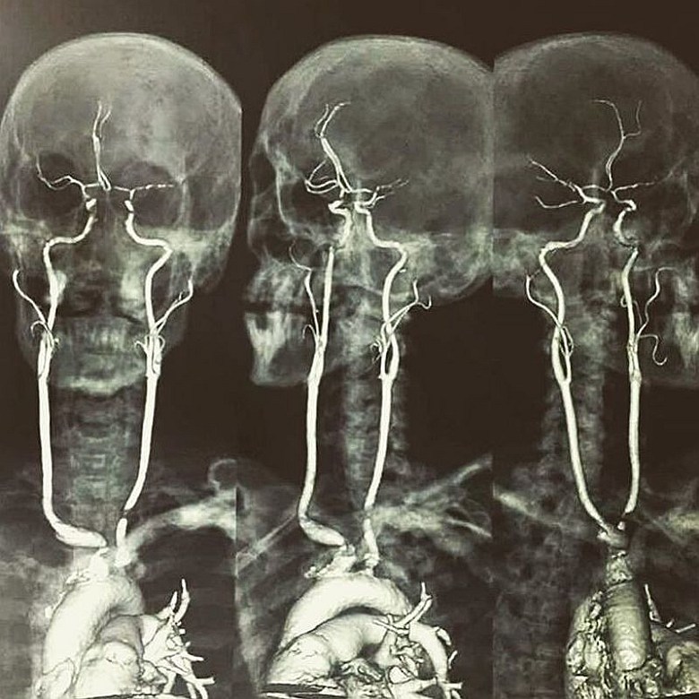 Tętnice szyjne na skanie rezonansu magnetycznego (MRI)