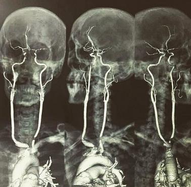 Tętnice szyjne na skanie rezonansu magnetycznego (MRI)