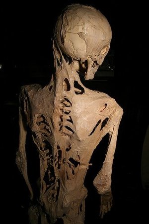 Rzadka choroba genetyczna - postępujące kostniejące zapalenie mięśni (fibrodysplazja)