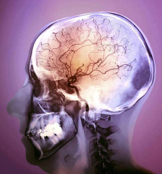 Barwny angiogram mózgu 48-letniego pacjenta po udarze