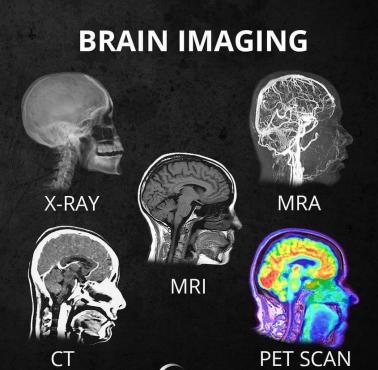 Obrazowanie mózgu z podziałem na metody: X-Ray, MRA, MRI, CT, PET