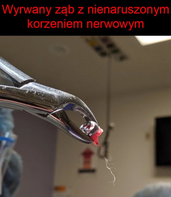 Ząb z nienaruszonym korzeniem nerwowym