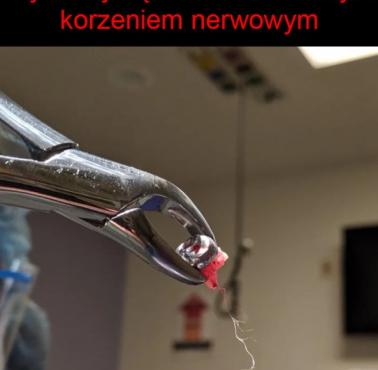 Ząb z nienaruszonym korzeniem nerwowym